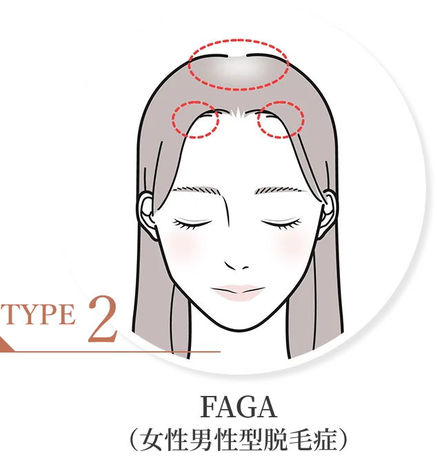 FAGA（女性男性型脱毛症）