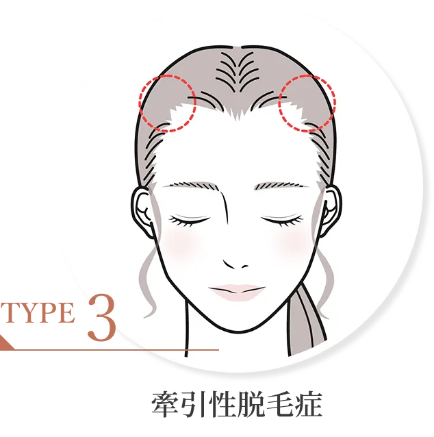牽引性脱毛症