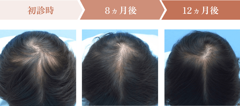 初診時、8ヵ月後、12ヵ月後の頭皮状態