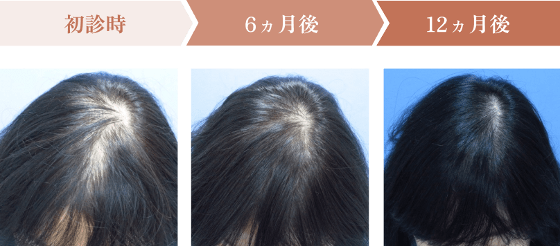 初診時、6ヵ月後、12ヵ月後の頭皮状態