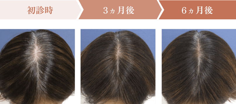 初診時、3ヵ月後、6ヵ月後の頭皮状態