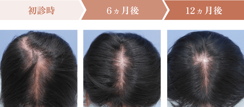 初診時、6ヵ月後、12ヵ月後の頭皮状態