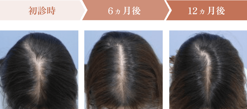 初診時、6ヵ月後、12ヵ月後の頭皮状態