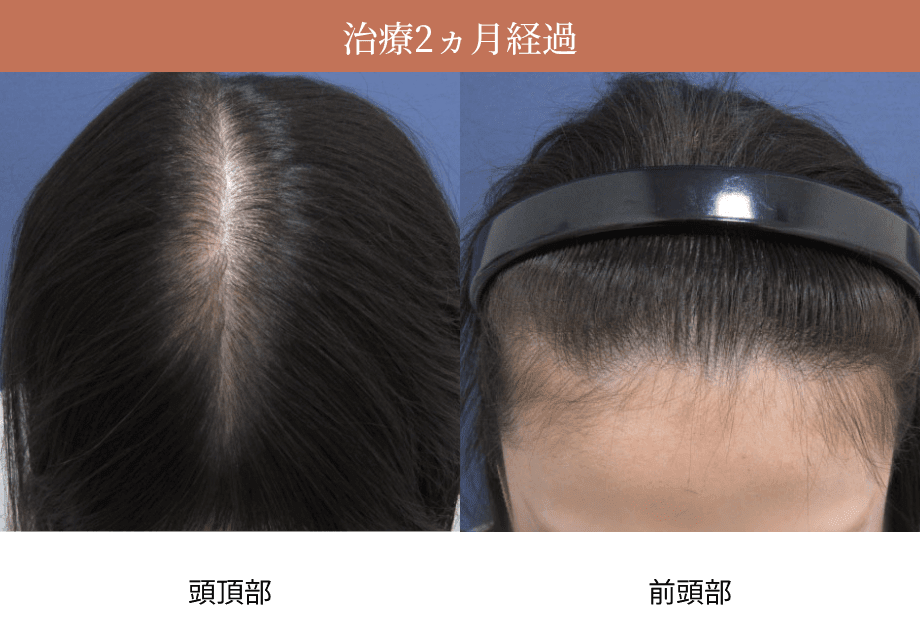 治療2ヵ月経過時の頭頂部・前頭部の画像