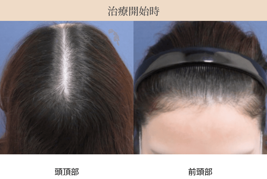 治療開始時の頭頂部・前頭部の画像