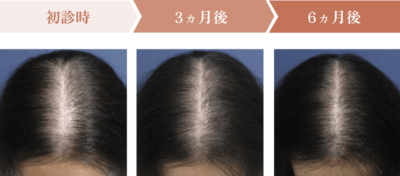 初診時、3ヵ月後、6ヵ月後の頭皮状態