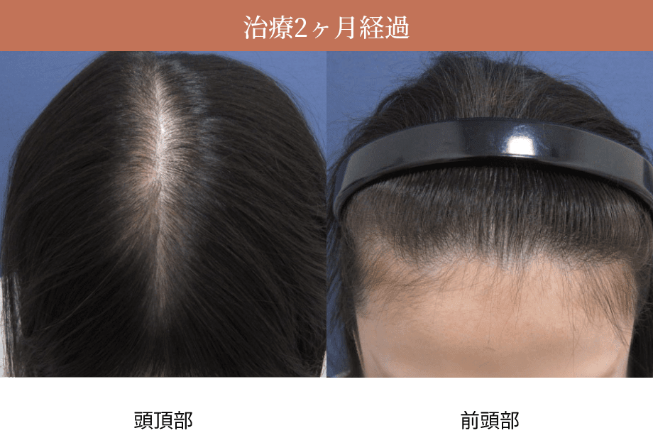 治療1ヶ月経過時の頭頂部・前頭部の画像