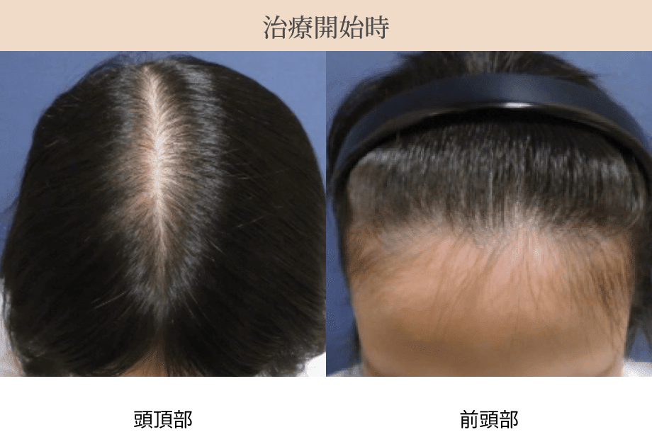 治療開始時の頭頂部・前頭部の画像