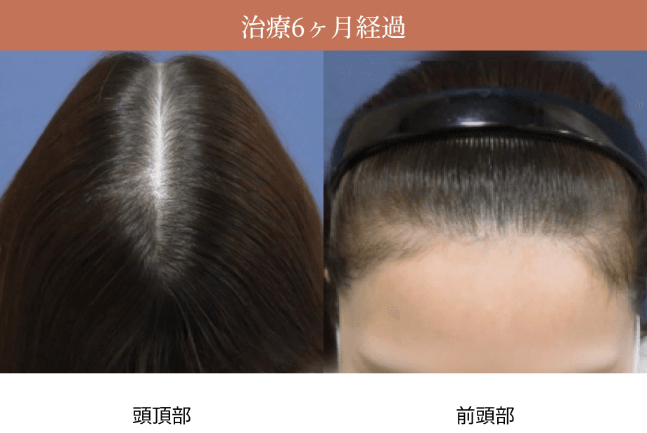 治療6ヶ月経過時の頭頂部・前頭部の画像