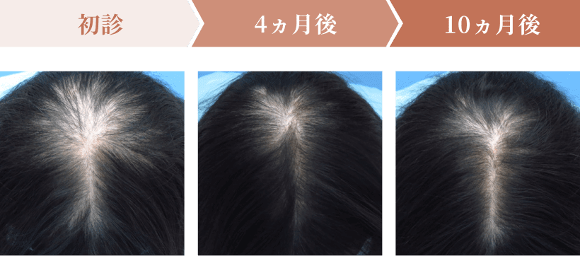 初診・4ヶ月後・10ヶ月後の頭皮の状態