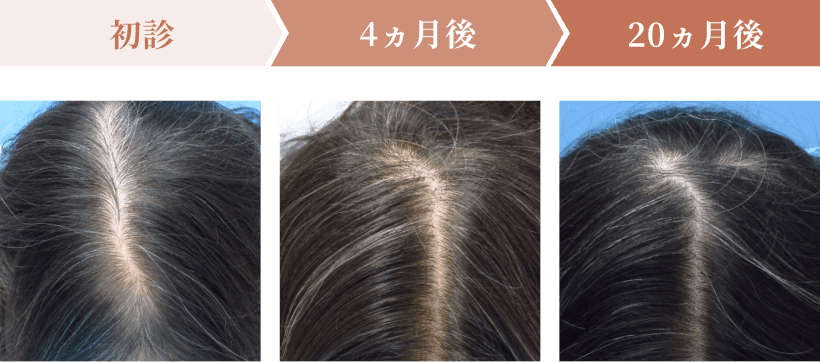 初診・4ヶ月後・ 20ヶ月後の頭皮の状態