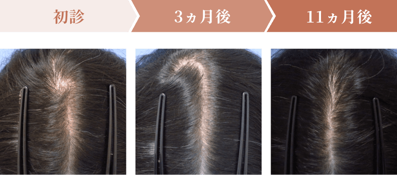 初診・4ヶ月後・11ヶ月後の頭皮の状態