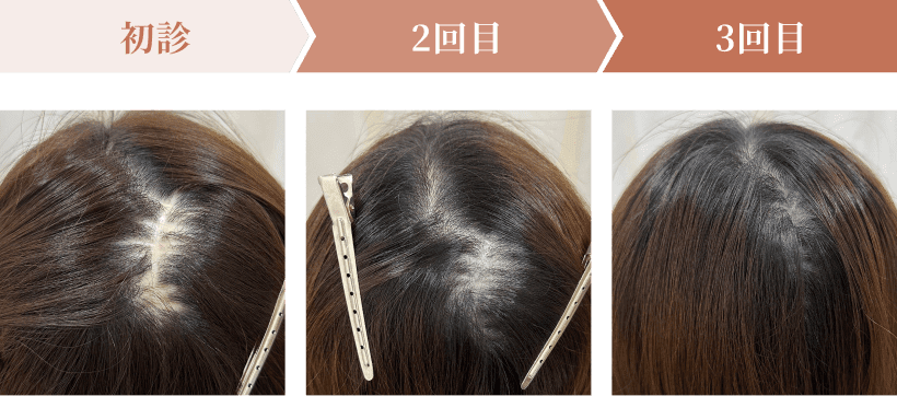 初診・2回目・3回目の頭皮の状態