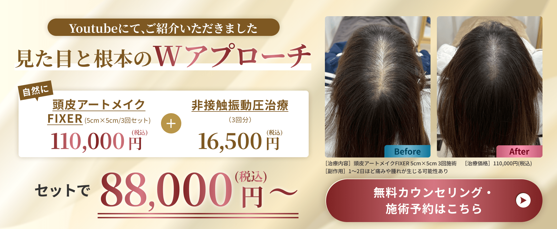 Youtubeにて、ご紹介いただきました 見た目と根本のWアプローチ 自然に 頭皮アートメイクFIXER（5cm×5cm/3回セット）（税込）110,000円 ＋ 非接触振動圧治療（3回分）（税込）16,500円 セットで88,000円～（税込） 【治療内容】頭皮アートメイクFIXER 5cm×5cm 3回施術【副作用】1〜2日は痛みや腫れが生じる可能性あり【治療価格】110,000円（税込） 無料カウンセリング・施術予約はこちら