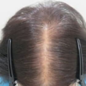 6ヵ月後の頭髪