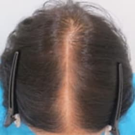 6ヵ月後の頭髪