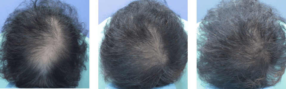 初診時6ヵ月後13ヵ月後