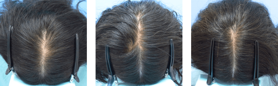 初診時6ヵ月後17ヵ月後