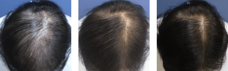 初診時6ヵ月後11ヵ月後