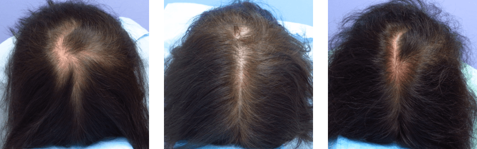 初診時6ヵ月後13ヵ月後