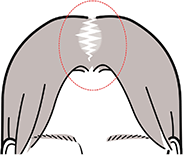びまん性脱毛症 イメージ図