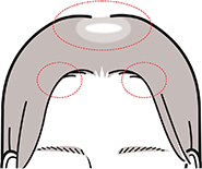 女性男性型脱毛症 イメージ図