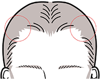 牽引性脱毛症 イメージ図