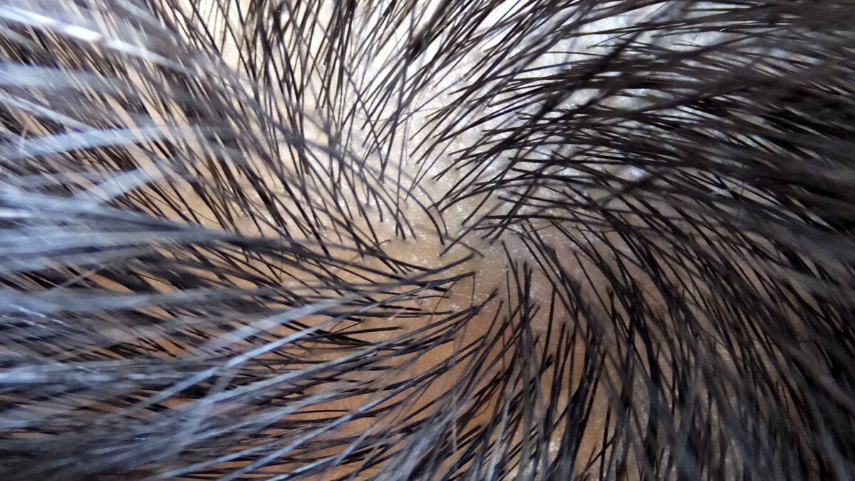 頭皮がベタ付く脂漏性皮膚炎（脱毛症）の原因と対策